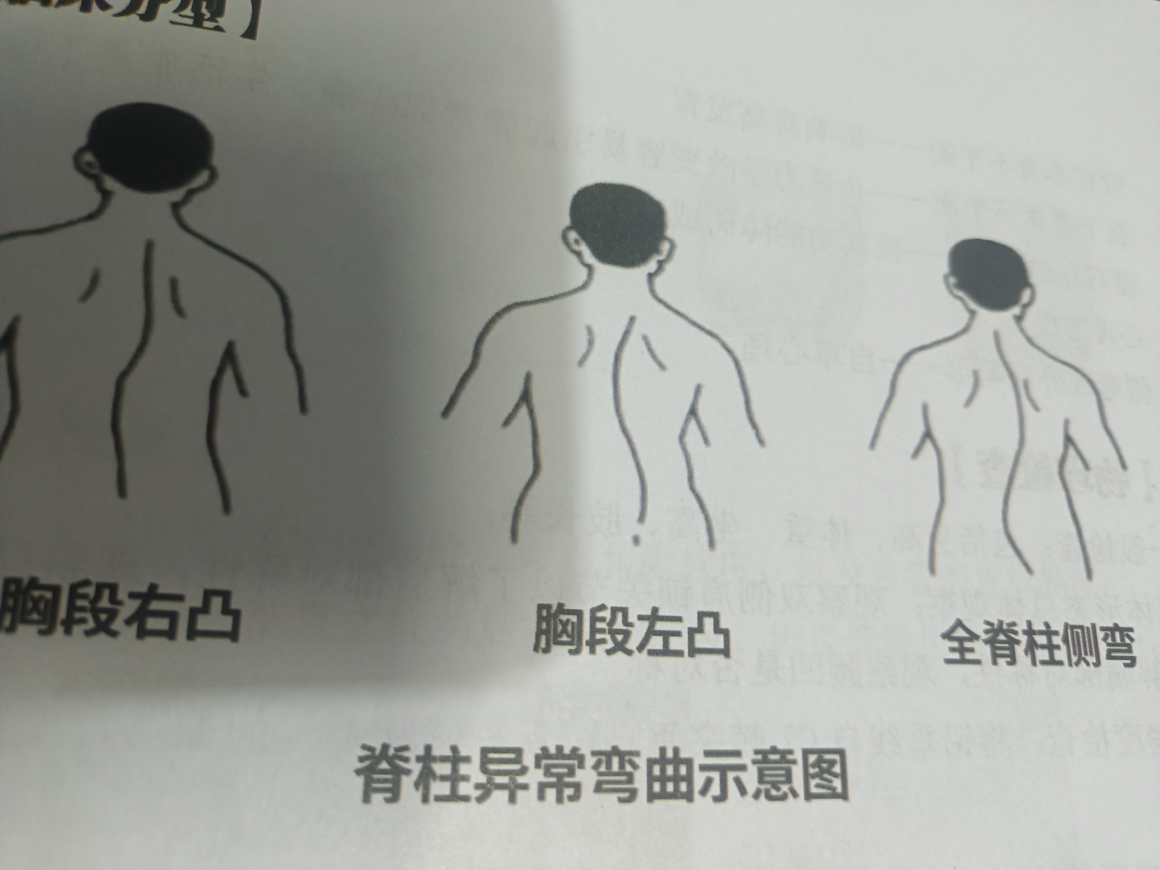 脊柱侧弯/次