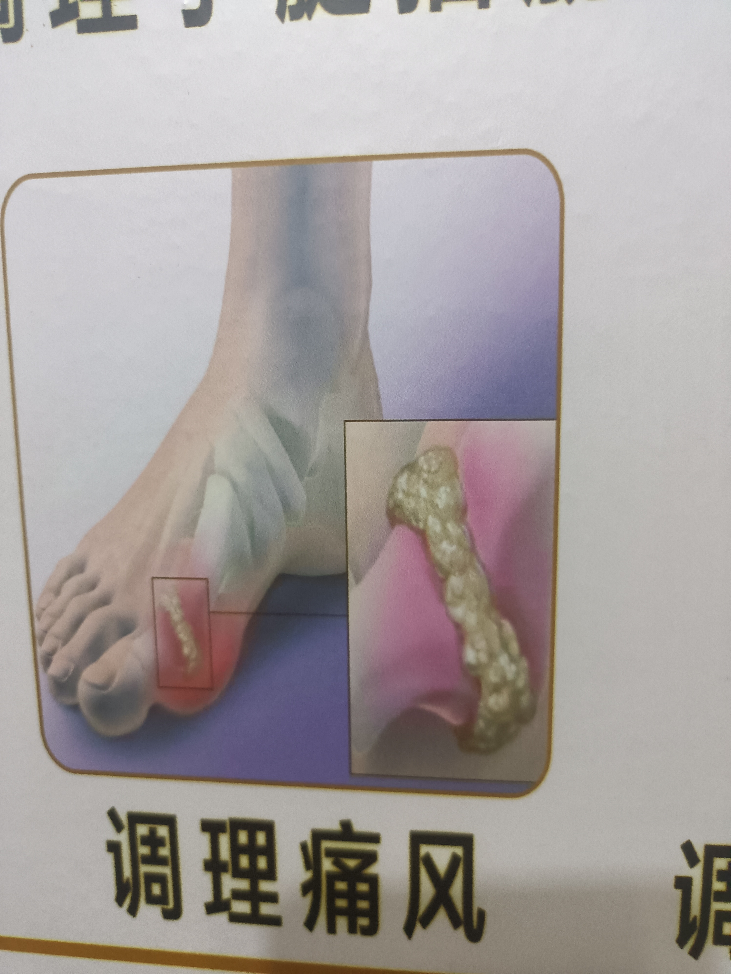调理痛风