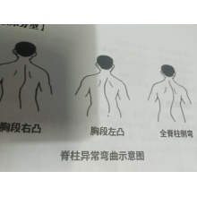 脊柱侧弯/次