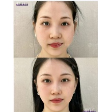 脸部护理骨雕+筋膜体验价